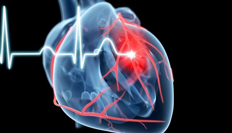 Cardiology Comparison of Heart Attack